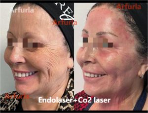 Arfurla Vertical 10600nm Fractional Co2 Laser For Skin Resurfacing Rejuvenation