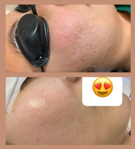Fractional Co2 laser machine-4