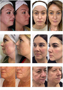Portable Microneedle RF Machine for Skin Rejuvenation and Skin Tightening