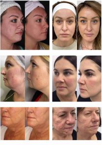 Portable Microneedle RF Machine for Skin Rejuvenation and Skin Tightening