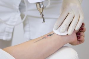 Pico laser tattoo removal machine