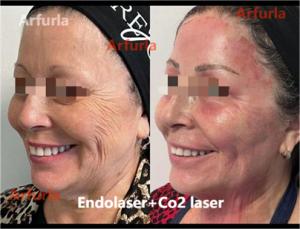 fractional co2 lasers machine-7