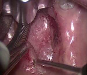 ENT handpiece-8