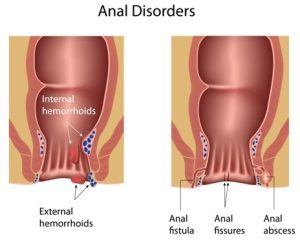 Hemorrhoids handle-4