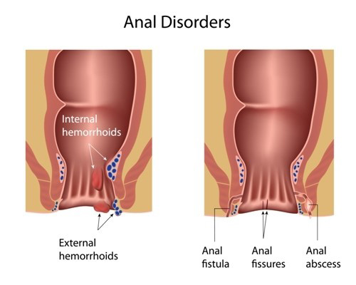 Hemorrhoids handle-4