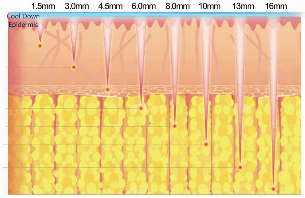 ICE Hifu 12 cartridge-2