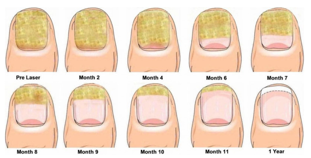 Nail fungus removal handle-4