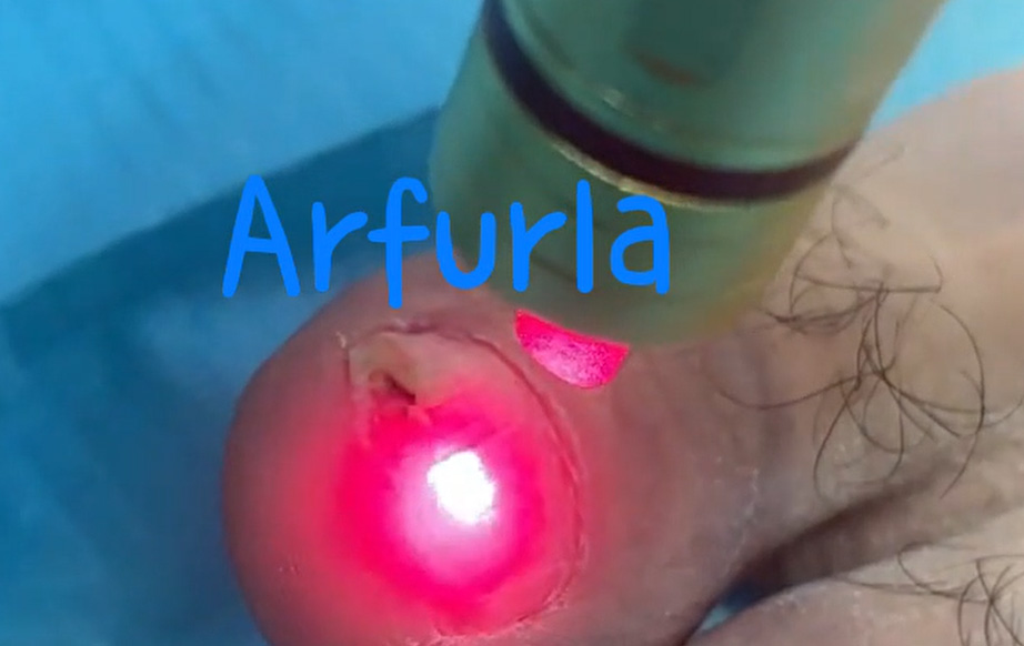 Nail fungus removal handle-5