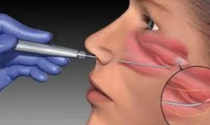 1Diode Laser Treatment (980nm & 1470nm) for ENT Surgery
