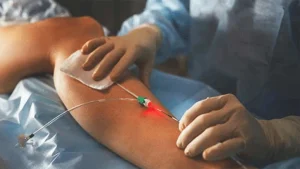 1Endovenous Laser Ablation - Laser treatment for varicose Veins Removal