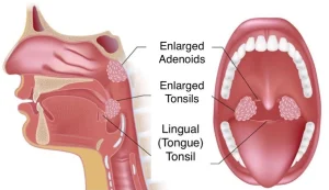 2Diode Laser Treatment (980nm & 1470nm) for ENT Surgery