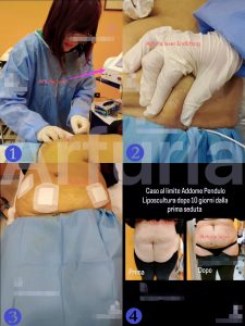 endolift laser