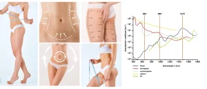 Endolaser Treatment 3