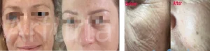 Fusion Plasma Treatment2