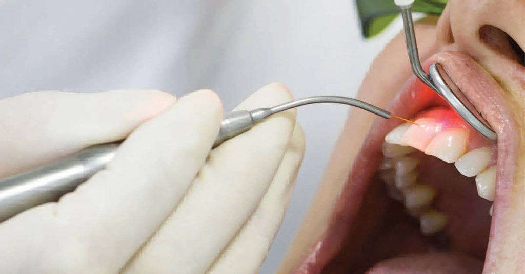 Arfurla Dentistry Laser Treatment