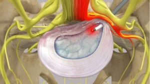 Percutaneous Laser Disc Decompression (PLDD)
