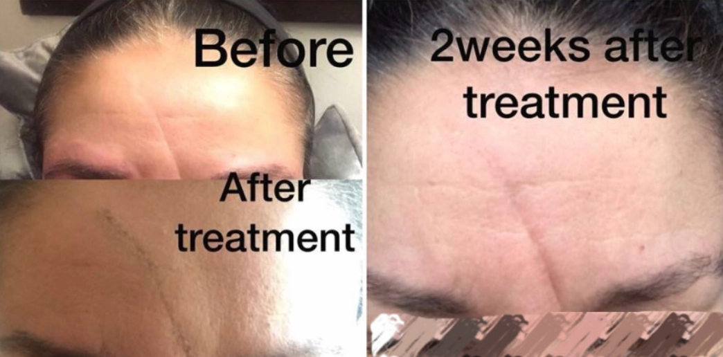 Fractional CO2 lasers treatment before and after