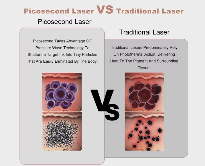 How Laser Tattoo Removal Works