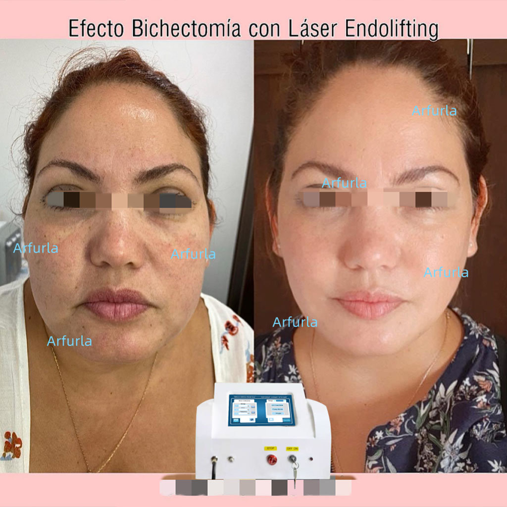 endolift