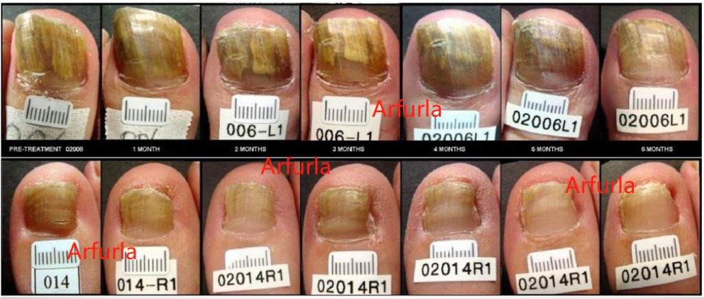 Clinical Outcomes Of Onychomycosis Podiatry Treatment