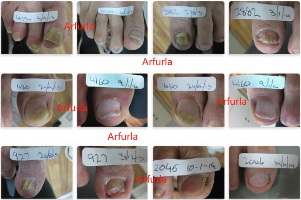 Advantages of Laser Treatment for Onychomycosis Podiatry
