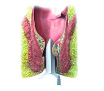 Laser Hemorrhoido Plasty – laser for hemorrhoids