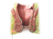 Sinus Pilonidalis treatment – laser for sinus pilonidalis