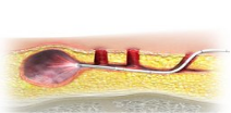 Laser Hemorrhoido Plasty – laser for hemorrhoids