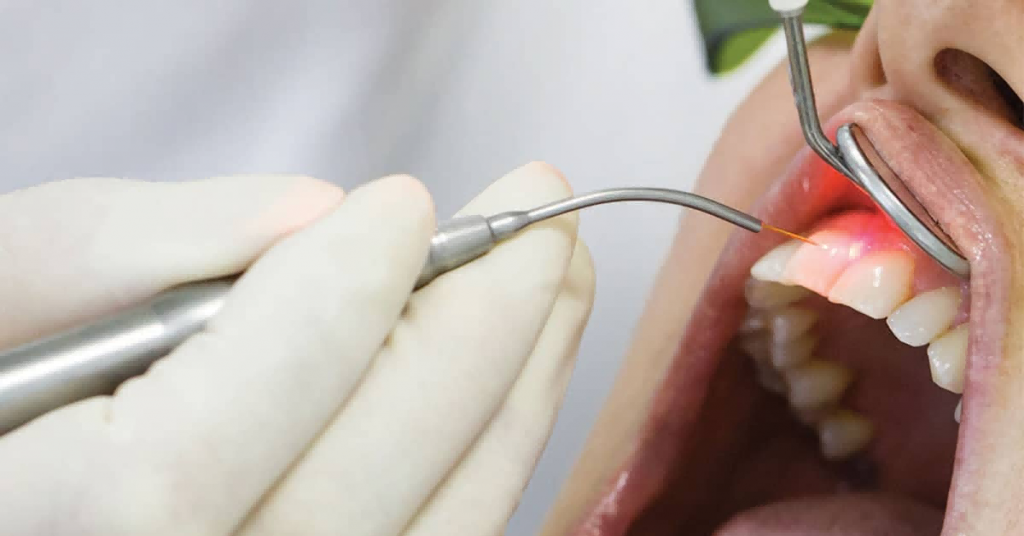 Arfurla Dentistry Laser Treatment Dental Diode Laser Soft Tissue What is the principle of diode lasers for oral soft tissue treatment?