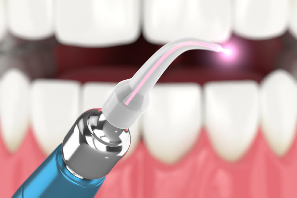 Arfurla Dentistry Laser Treatment Dental Diode Laser Soft Tissue What is the principle of diode lasers for oral soft tissue treatment?