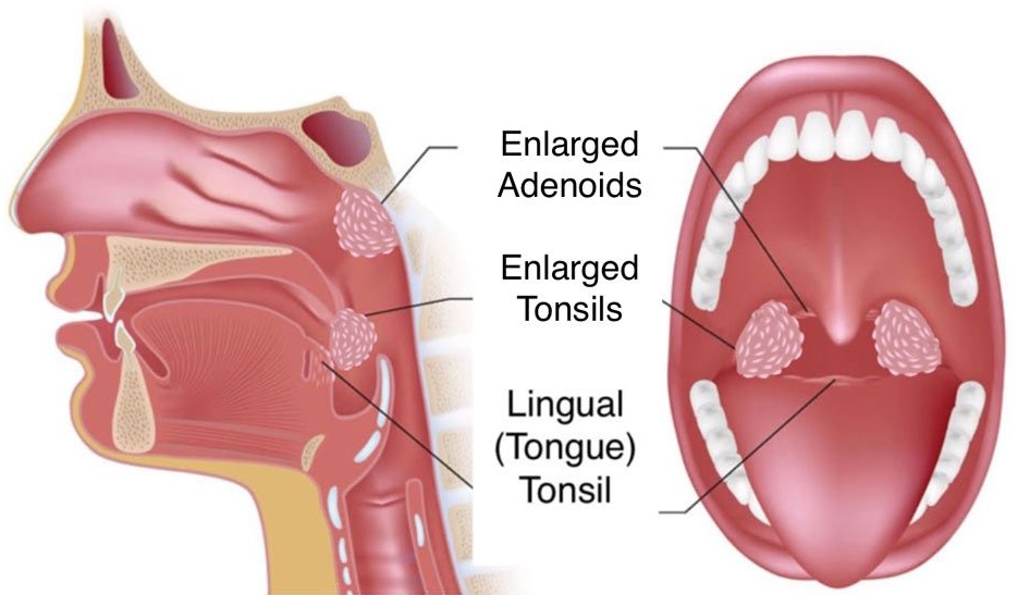 Laryngology On ENT Laser Surgery Treatment