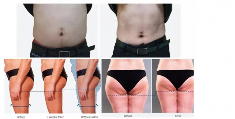 Body slimming machine6