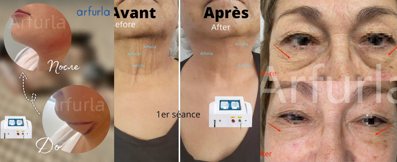 Before and After