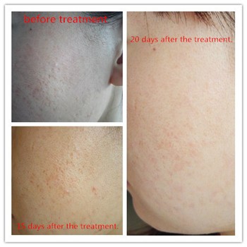 Fractional Co2 laser machine-5