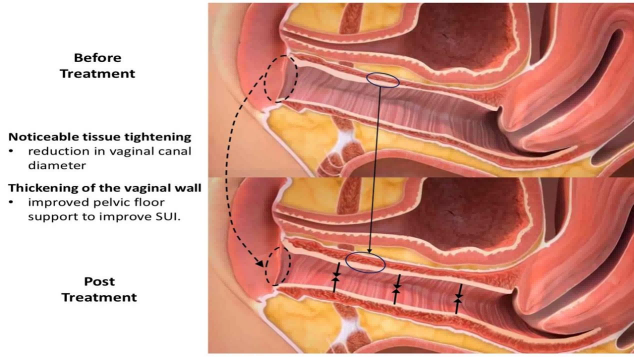 8.This dual-phase process not only addresses symptoms but also promotes natural rejuvenation, restoring the vaginal canal’s elasticity, tone, and functional resilience.