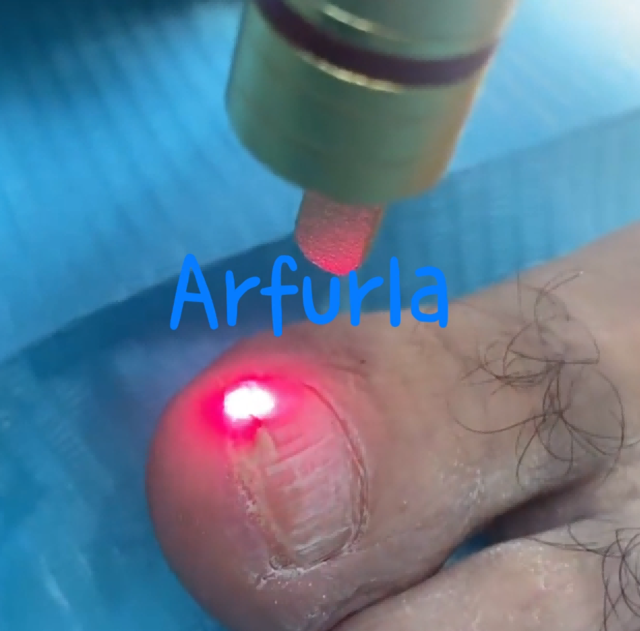 Laser Treatment Principle for Onychomycosis Podiatry