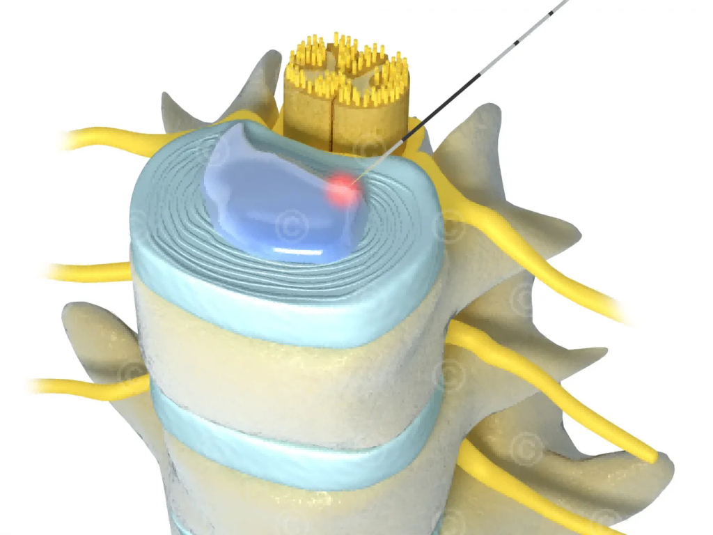 How PLDD Laser Treatment Works
