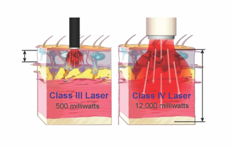 Class IV Therapeutic Laser System for Medical and Aesthetic Applications Empowering Healing with High-Power Photobiomodulation