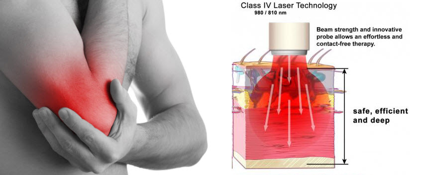 Class IV Therapeutic Laser System for Medical and Aesthetic Applications Empowering Healing with High-Power Photobiomodulation