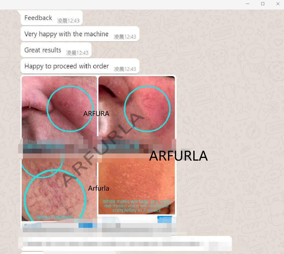 Conclusion of Arfurla 980nm Spider Veins Laser Treatment