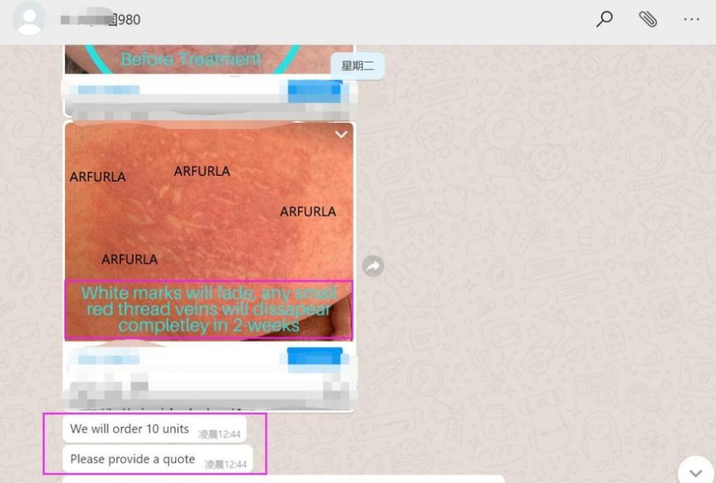 Conclusion of Arfurla 980nm Spider Veins Laser Treatment