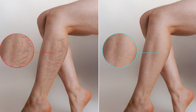 Arfurla Diode Laser 980nm Spider Veins Removal Laser Treatment Treatment Principle Of 980nm Spider Veins Removal Laser