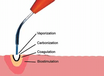 Arfurla Diode Laser Soft Tissue Cutting On Hemorrhoids Dentistry ENT Introduction of Soft Tissue Cutting Treatment