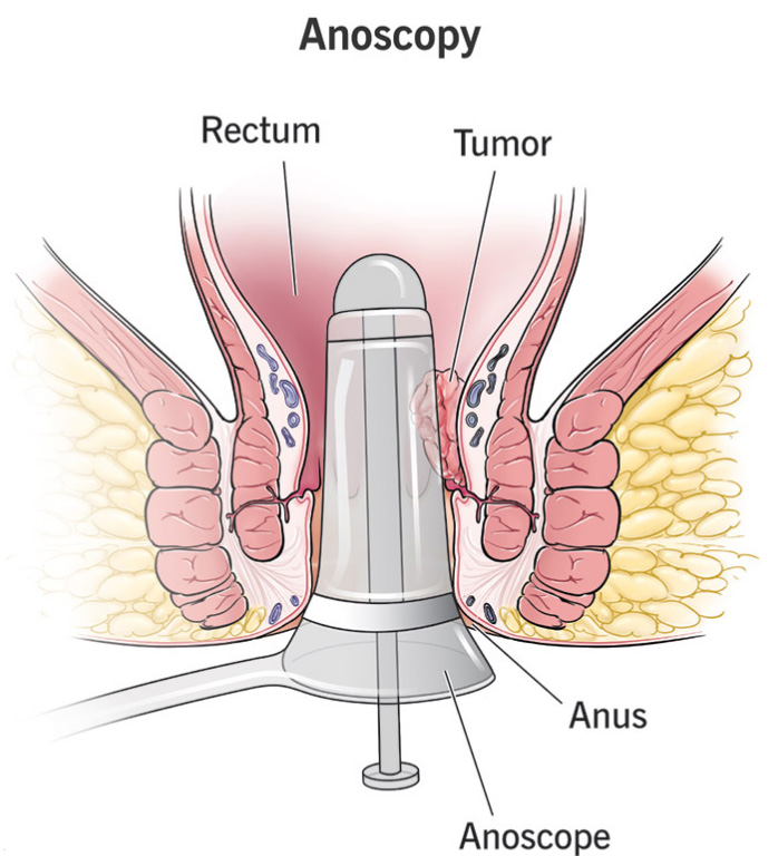 Anoscope-2