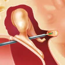 ENT handpiece-2