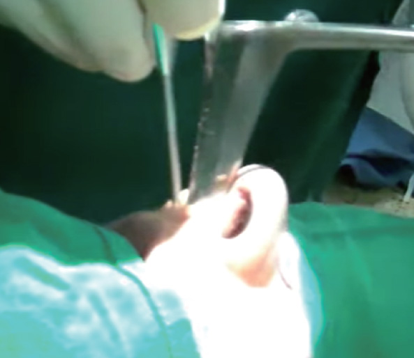 ENT handpiece-7