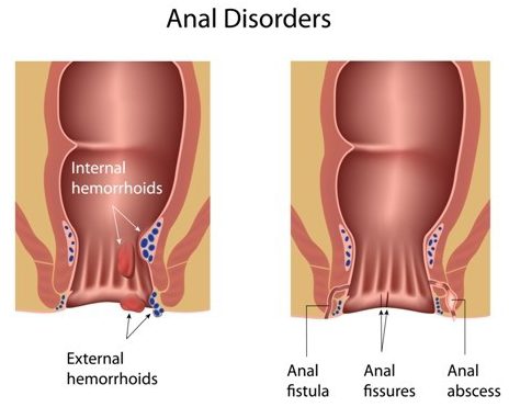 Hemorrhoids handle-4