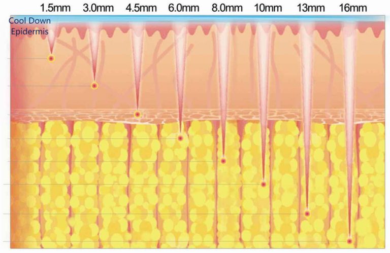 ICE Hifu 12 cartridge-2