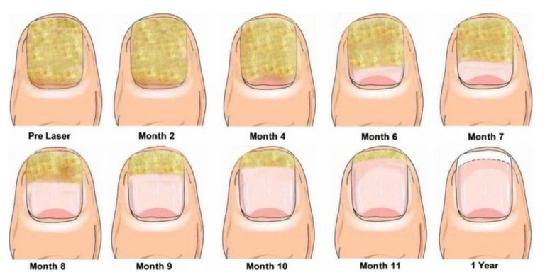 Nail fungus removal handle-4