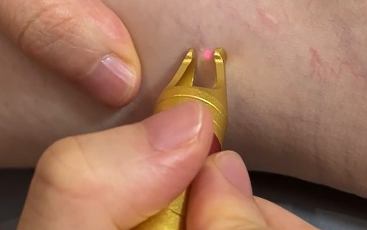 Vascular removal handle-4